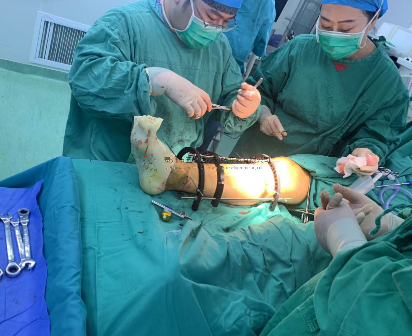 【望京醫院】不開刀治骨折病例分享——脛骨遠端骨折腓骨骨折 【望京醫院】不開刀治骨折病例分享——脛骨遠端骨折腓骨骨折